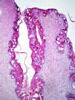 カタル性膀胱炎、PAS染色。