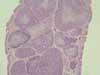 Fabricius嚢のリンパ濾胞における腫瘍性リンパ球増殖。HE染色、x20。