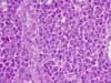 肝臓門脈周囲領域における腫瘍細胞増殖。HE染色、x200。