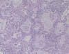リンパ球浸潤を伴った肺胞壁の肥厚と2型肺胞上皮細胞の増殖。 HE染色、x200。
