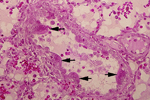 豚、ニパウイルス感染症、肺。細気管支上皮細胞の合胞体巨細胞形成（矢印）。HE染色標本。「第45回獣医病理学研修会提出標本、標本番号880　豚の肺、動衛研・つくば」